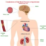 Complications of High Blood Pressure or Hypertension